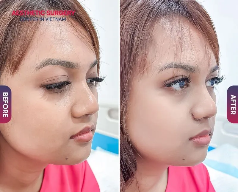 Clients are always supported by Aesthetic Surgery Center during the post-operative care period, ensuring a smooth and even recovery for the nose.