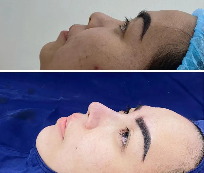 Galaxy Aesthetics delivers natural, elegant, and balanced nose shapes for clients.