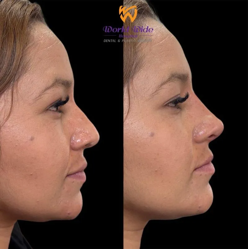 Worldwide Dentistry, a rhinoplasty clinic in Vietnam, helps enhance and refine each client’s nose shape.