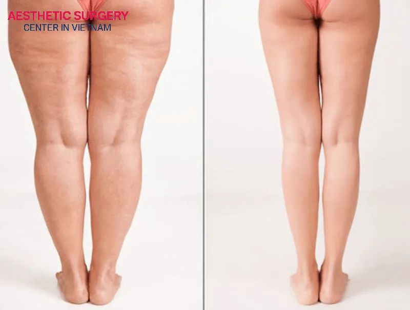 This method helps remove excess fat accumulated in areas that are difficult to slim down through long-term exercise or dieting.