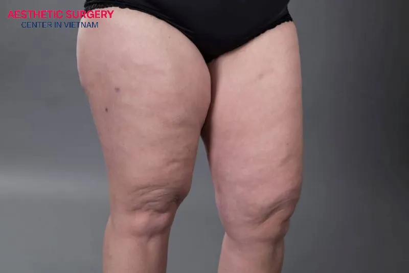 Thigh liposuction is suitable for those with a moderate amount of fat, good health, and a desire to improve their leg shape.