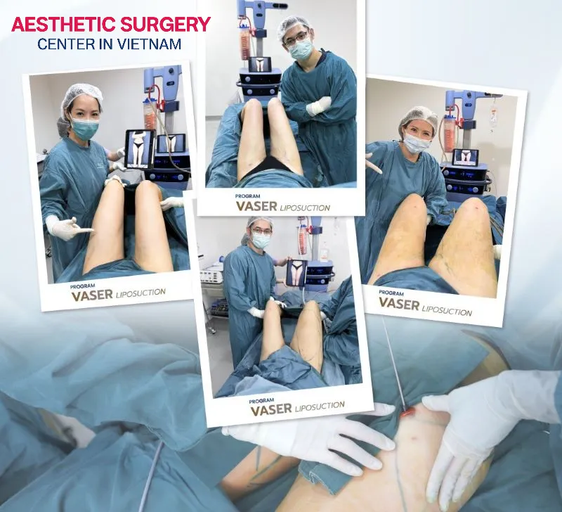 Thigh liposuction is a common and safe procedure when performed at reputable clinics by highly qualified surgeons.