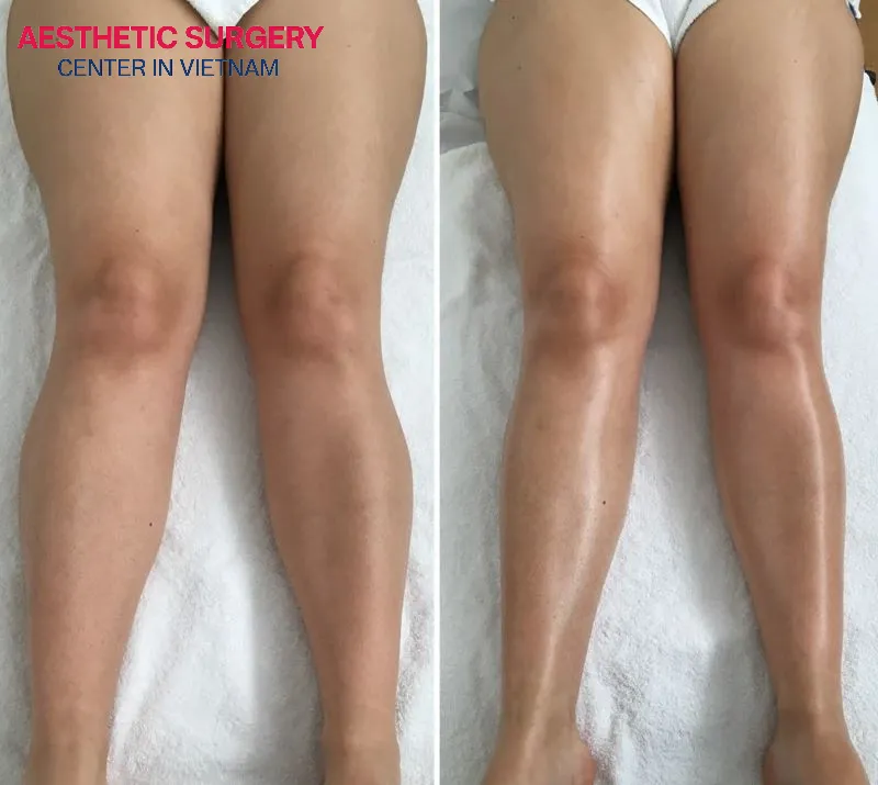 The client’s thigh shape before and after undergoing thigh liposuction at Aesthetic Surgery Center.
