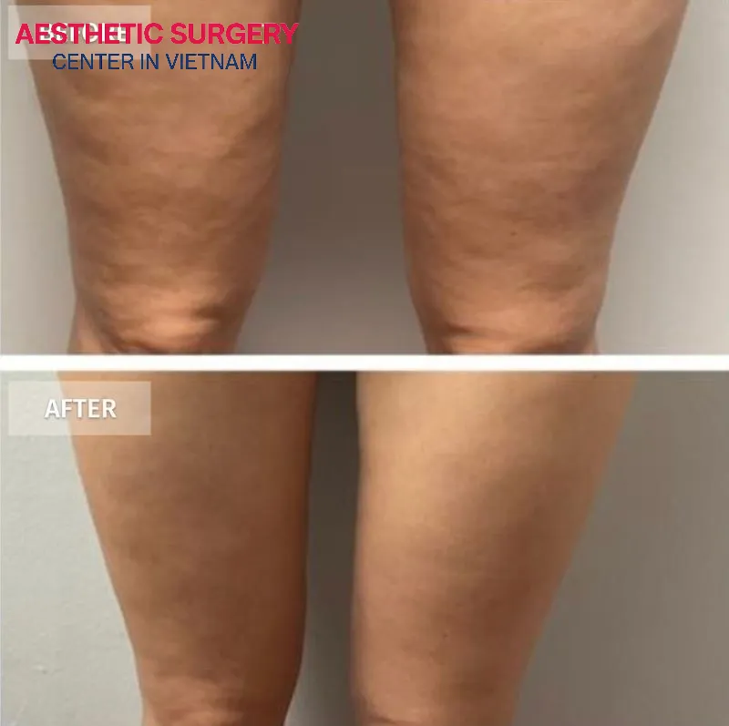After undergoing thigh liposuction at Aesthetic Surgery Center and following proper care and recovery, the thigh contours have become slimmer and more balanced.