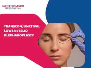 Transconjunctival Lower Eyelid Blepharoplasty