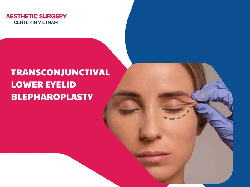 Transconjunctival Lower Eyelid Blepharoplasty