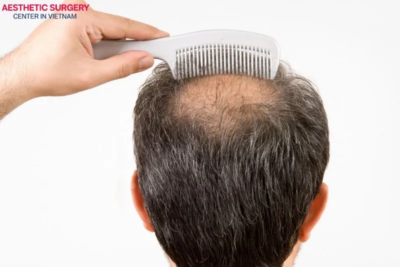 Overharvesting the donor area is one of the common reasons why hair transplant scars become more noticeable and less aesthetic.