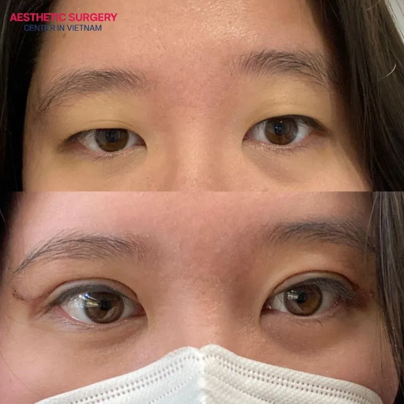 The Asian eyelid crease procedure customizes the eyelid shape for each individual, creating naturally large and round eyes.