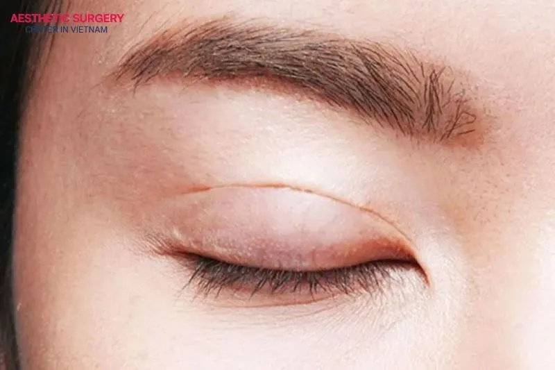 The suture eyelid method is usually suitable for those with thin eyelid skin, where the surgeon uses specialized threads to connect the skin and muscle to form the crease.