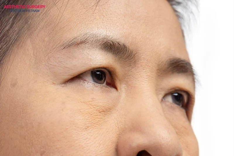 Those with drooping or hidden eyelids can undergo the incision method to achieve a long-lasting eyelid crease.