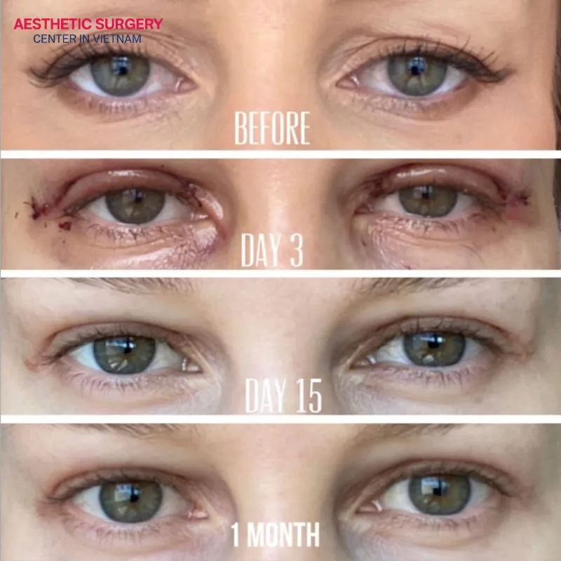 Recovery Process After Incision Asian Blepharoplasty