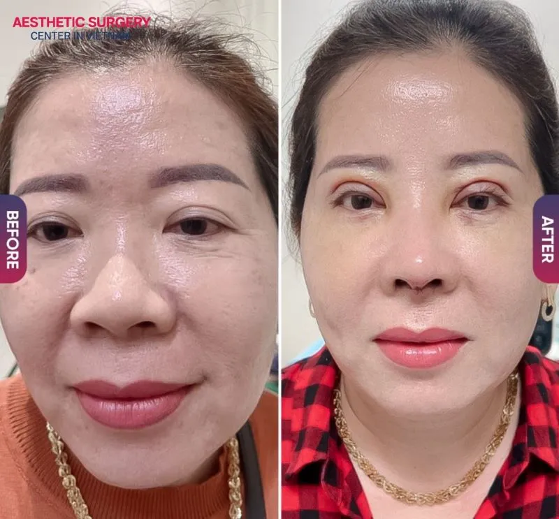 The cost of incision eyelid surgery currently ranges from 15–40 million VND, with the incision method typically being more expensive but offering longer-lasting results.