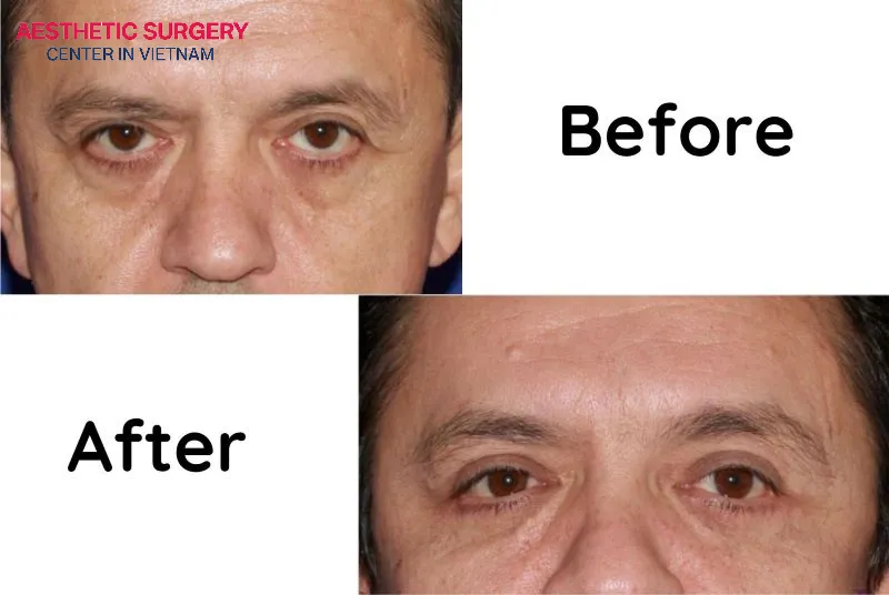 Patients may experience temporary loss of sensation in the forehead area after a brow lift.