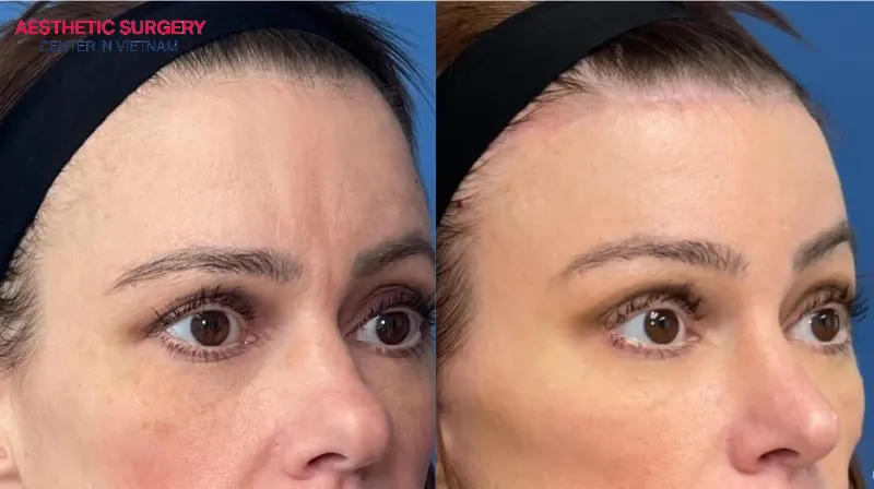 Eyebrow asymmetry may gradually improve as the swelling in the surgical area decreases.