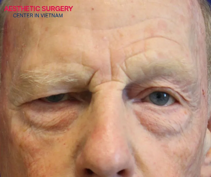 If the surgeon is not careful, sensory nerves can be easily damaged.