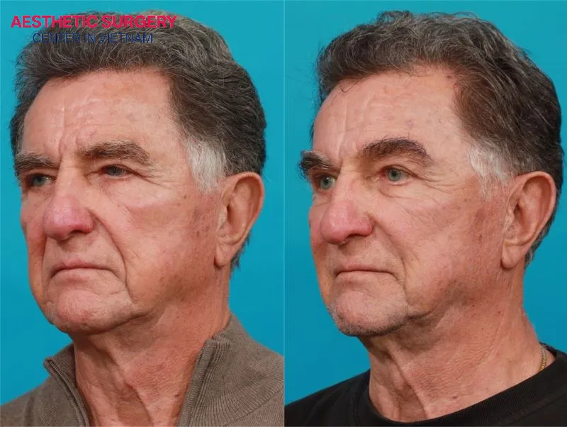 Clients after undergoing a brow lift at Aesthetic Surgery Center