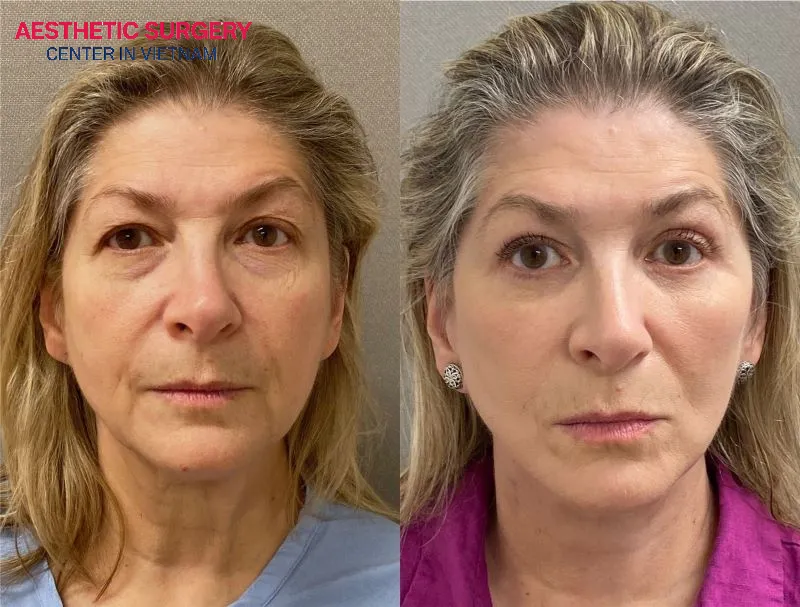 Before-and-after images of clients whose asymmetrical eyebrows were corrected at Aesthetic Surgery Center