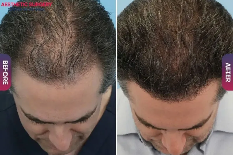 Before-and-after images of patients following hair transplantation at Aesthetic Surgery Center.