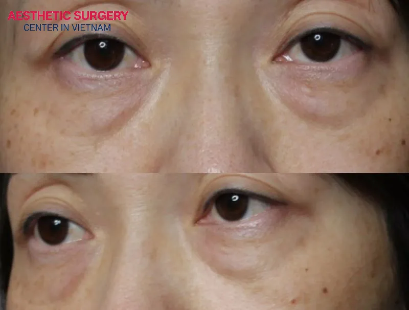 A brow lift corrects sagging eyelids, but does a brow lift hurt?