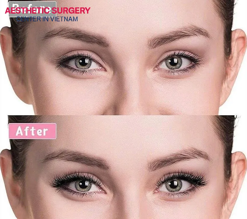 Mild swelling and tightness occur only during the first few days, and within a few weeks, the face will almost fully stabilize.