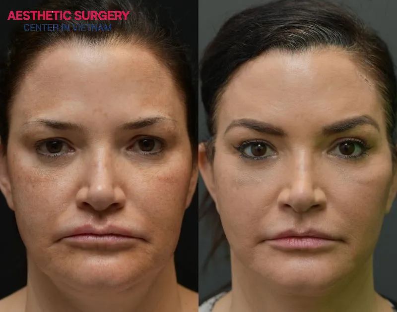 Clients undergoing brow lift procedures at Aesthetic Surgery Center