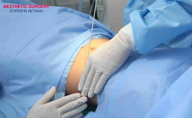 Is Liposuction Painful? Liposuction is usually painless during the procedure but can be painful afterward.