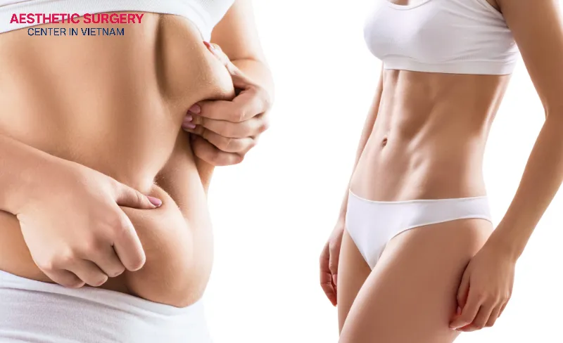 The amount of fat to be removed determines the level of pain after liposuction.