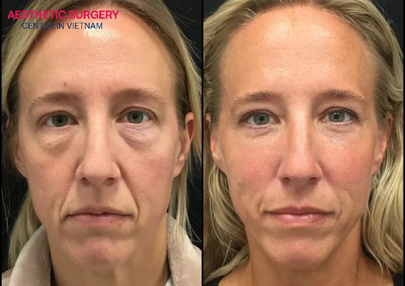 How long does eyelid surgery take to heal? Usually, after 2–3 months, the incision scars gradually fade and blend into the eyelid crease, giving a more natural appearance.