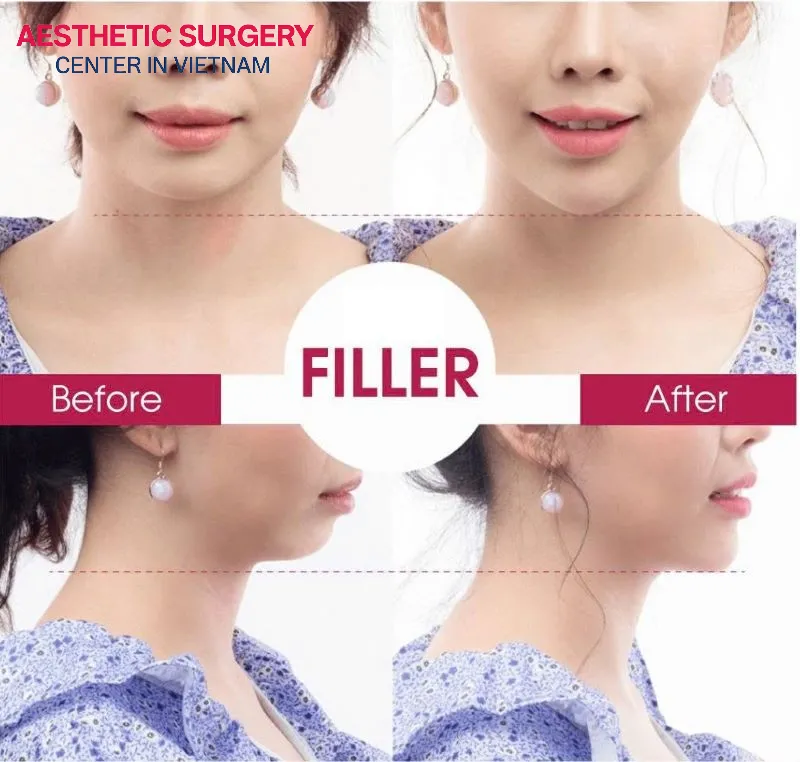 Before-and-after images of clients who received chin filler at Aesthetic Surgery Center Vietnam.