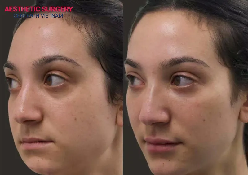 Recovery time after chin filler: within 3–5 days, swelling and bruising are significantly reduced, the chin feels softer, and the contours gradually become more defined.