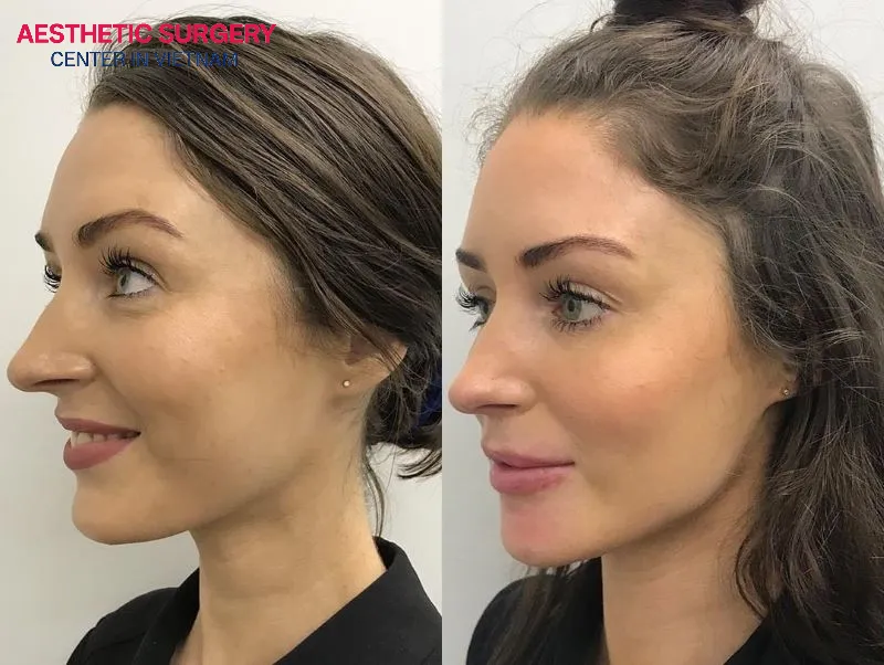 Most swelling and bruising have completely disappeared, allowing you to resume light daily activities.