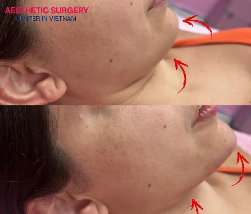 After 2–4 weeks, the filler is fully settled, well integrated with the skin, and no longer feels firm to the touch.