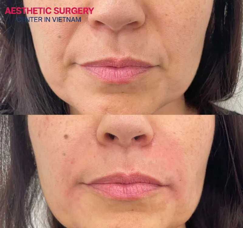 After about a week following filler injections, swelling will noticeably decrease, and your facial contours will appear more balanced.