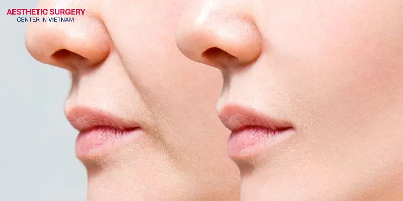 People with a fast metabolism tend to have fillers integrate with their skin more quickly, but the filler may also dissolve naturally at a faster rate.