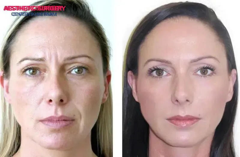 The youthful, radiant look of our clients after receiving filler injections at Aesthetic Surgery Center.
