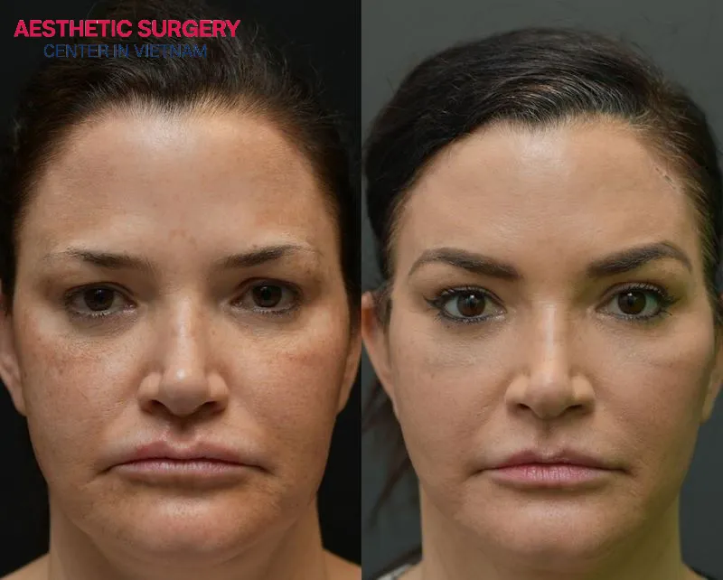 Before-and-after images of clients who have undergone brow lifts at Aesthetic Surgery Center.