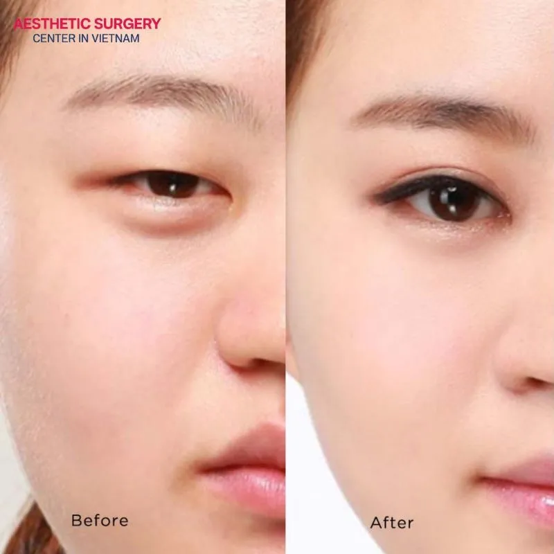 Avoiding eggs during the healing period supports a more beautiful eyelid shape as expected.