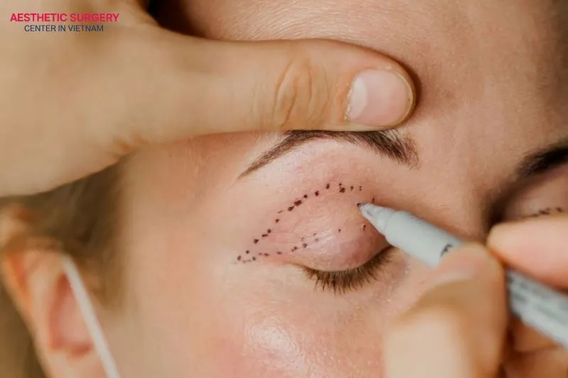 After eyelid surgery, you will see the clearest and most beautiful eyelid shape after about 1–3 months.