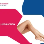 Knee liposuction: Create perfect leg balance