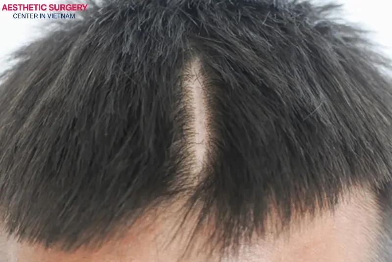 Recipient area scars can still occur even with modern hair transplant techniques if the procedure is not performed correctly.