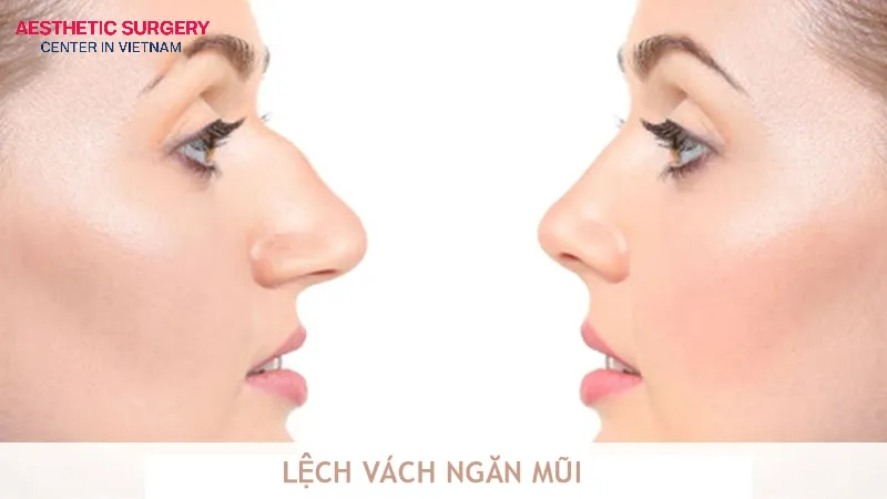 Septoplasty for correcting deviation and enhancing aesthetics