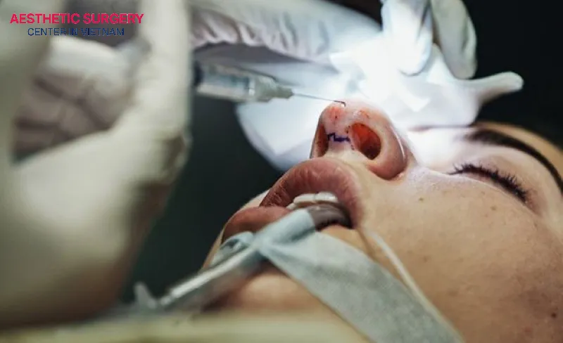 Traditional Septoplasty procedure.
