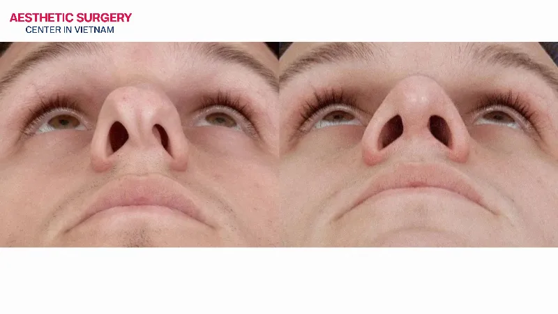The condition of a deviated nasal septum is noticeably improved.