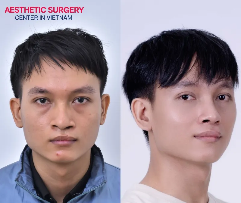 Facial features become more refined and harmonious.