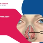 Septoplasty