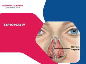 Septoplasty