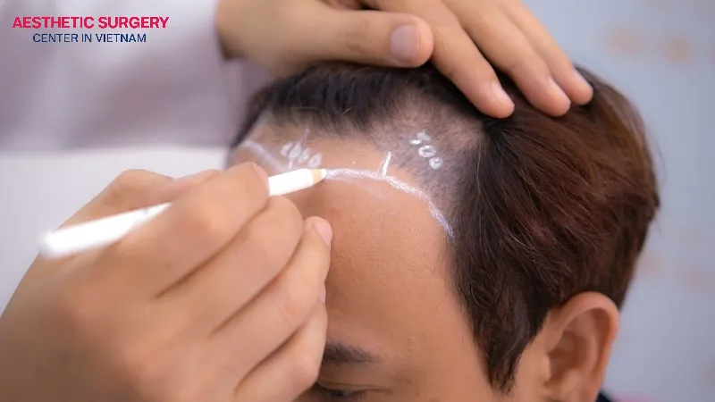 Ages 18 to 25 are considered the suitable range to start hair transplant evaluation.