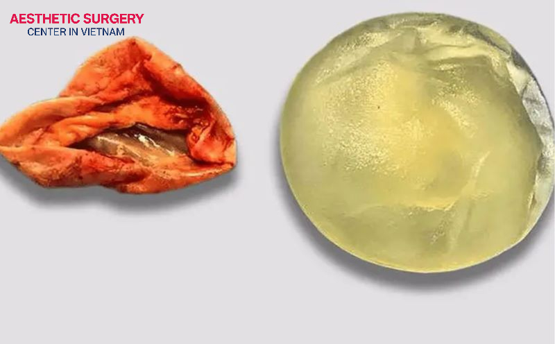 In severe cases, surgery may be required to remove or replace the implant.