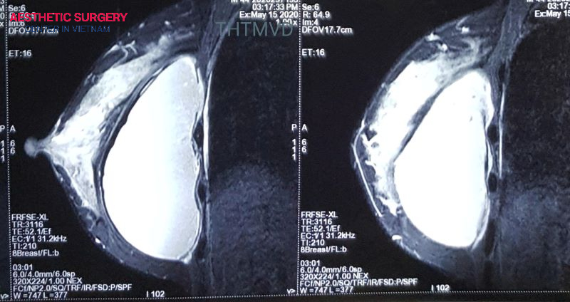 Silicone breast implants can rupture, so regular MRI scans are recommended to detect any risks as early as possible.