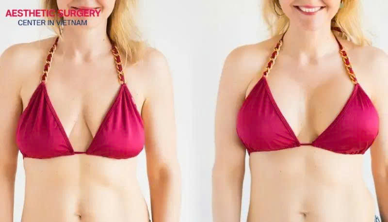 Images of clients undergoing breast augmentation at Aesthetics Surgery Center and achieving their desired results.